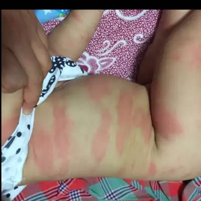 其他回答 0                             荨麻疹的话确实是比较严重