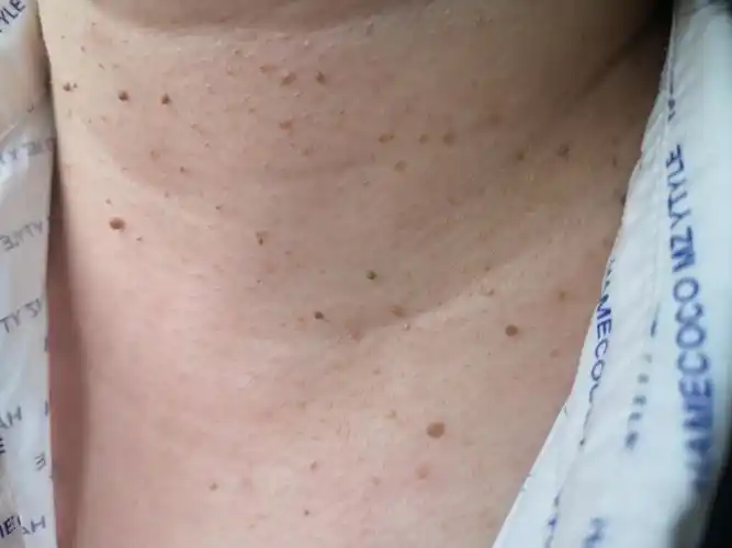 脖子上的小疙瘩真的不是丝状疣