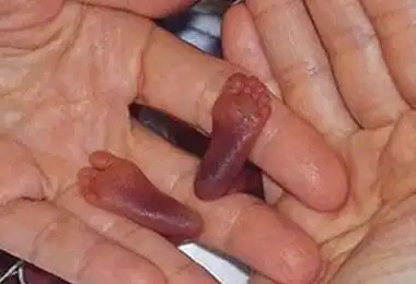 怀孕22周来到了人间,她是世界上存活下来的最小的婴儿,看的人心疼