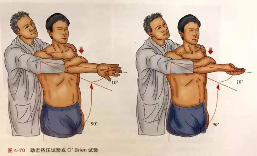 肩关节slap损伤的分型与临床诊断