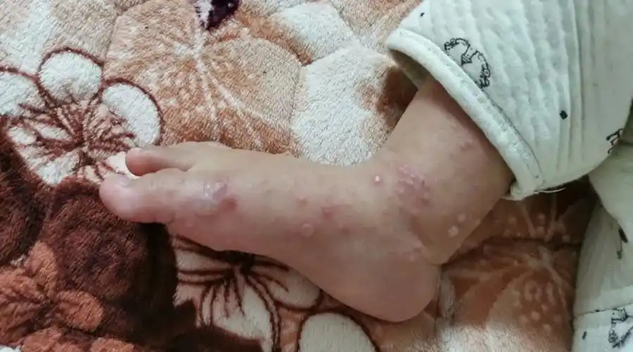 亲历手足口的30天没想到熬过高烧之后真正的崩溃才开始