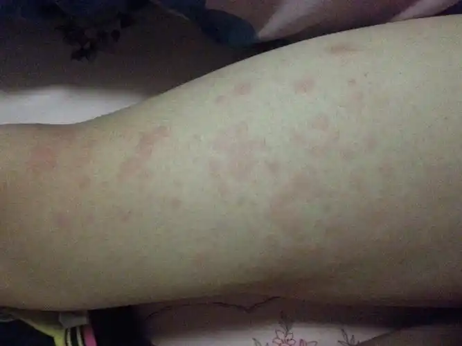大腿痒,一挠起一片包,是什么?有图