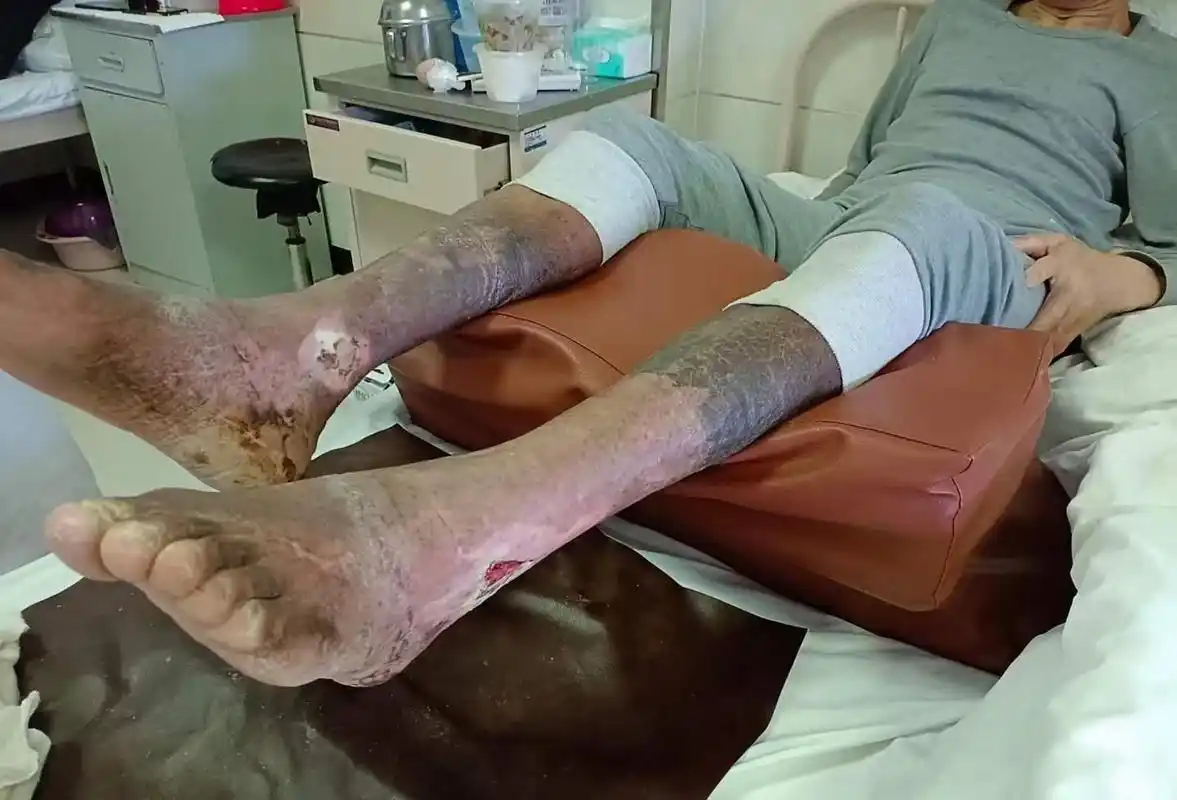 小腿下段皮肤溃疡,这个病为啥难治疗?