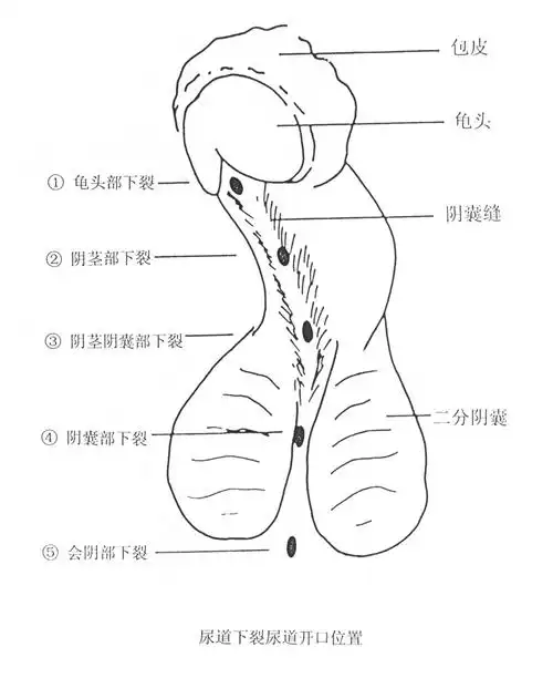 尿道下裂到底有多可怕