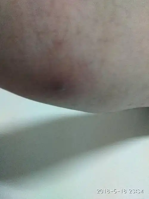 腿上长了个开始不痛不痒,等快成熟时,很痛,不能碰.