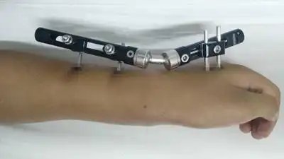 闭合复位骨外固定微创治疗手腕部骨折