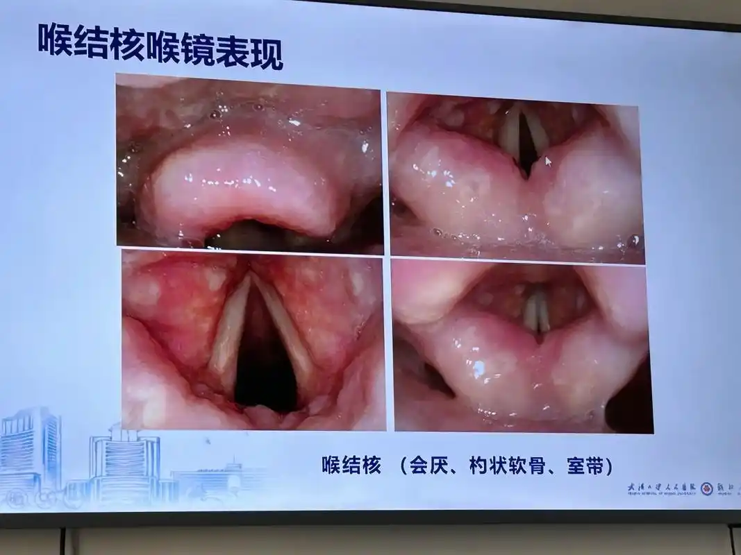 咽喉痛,异物感,溃疡需要警惕喉结核#喉咙异物感 #咽喉溃疡# - 抖音