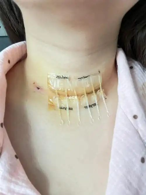 甲癌术后第六天