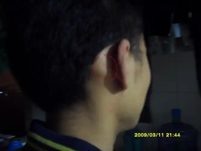 耳朵后面的骨头异常长大(右边是左边的一倍)而且时常有疼的感觉感冒时