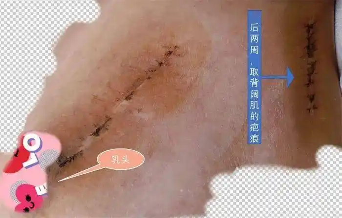 20岁女孩乳腺癌切除左乳,2年后"长"出来了,原来……_魏海燕_乳房_手术