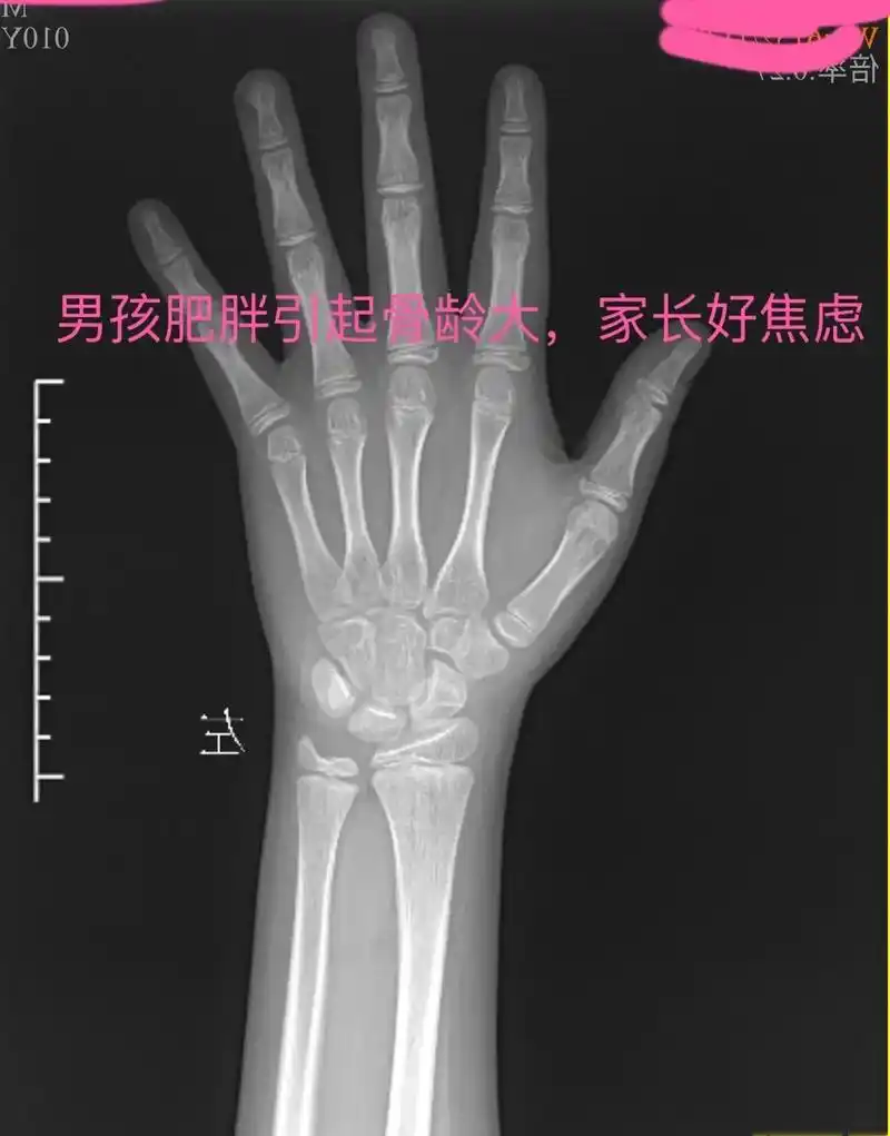 男孩肥胖引起的骨龄大家长很焦虑