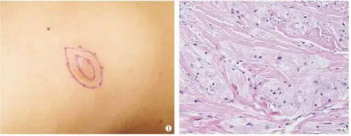 皮肤颗粒细胞瘤1 例