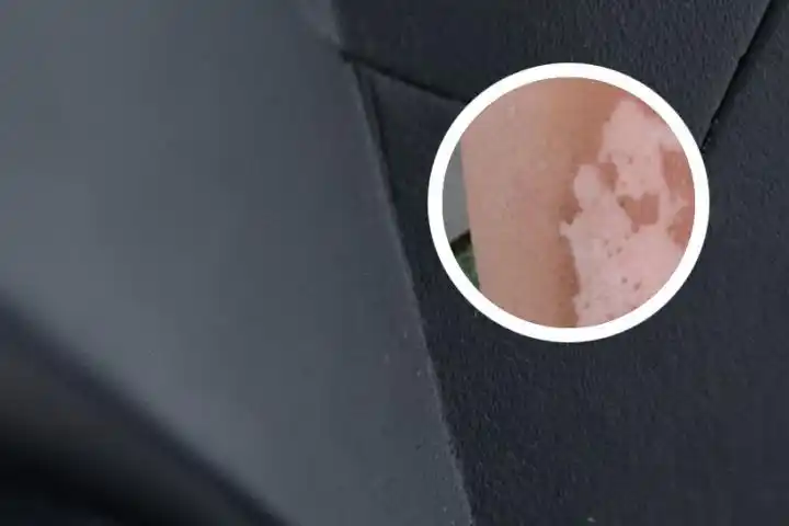 肚子上长了白斑是怎么回事