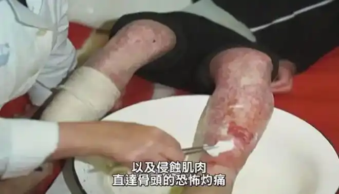 东海村核临界事故