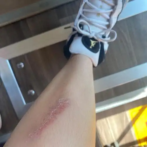 第一次到这个城市,机场大巴和别的车撞上,我腿受伤了