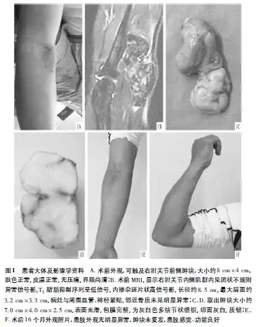 右侧肘关节巨大腱鞘纤维瘤1例