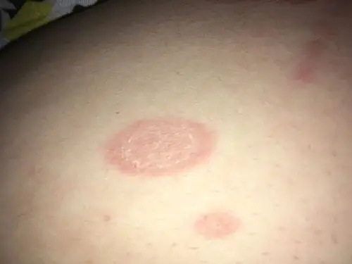 请医生帮我看看身上的红色圆斑是什么毛病