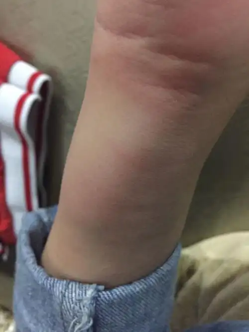 每次被蚊子一咬就会肿很大很大一个包怎么回事啊