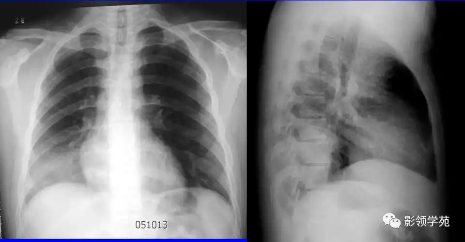 沿肺纹理有模糊的斑片状阴影.肺纹理增粗,模糊.x线表现