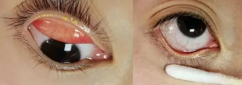 睑板腺功能障碍(干眼症的常见病因)