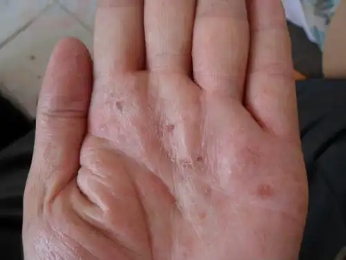 手上长小水泡很痒是什么病