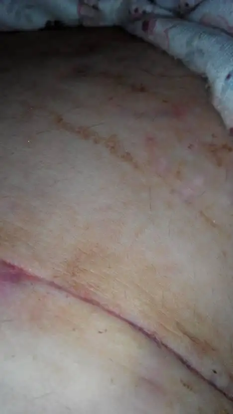 周围有点疼.帮忙看看恢复的怎么样