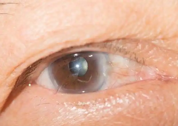 老年人老眼昏花就是老花眼提醒也可能是这3种疾病在作怪