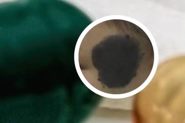 身上长咖啡斑是怎么回事大人