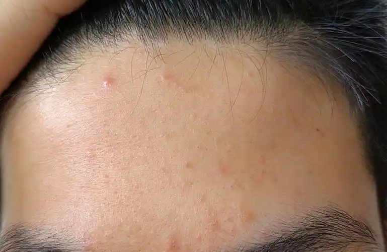 粉刺黑头洗不干净怎么办