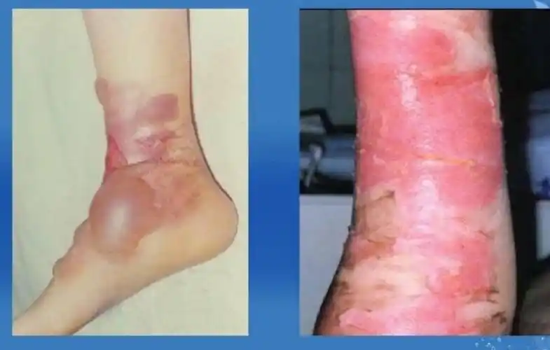 浅ii度烧伤:       局部红肿明显,有大小不等的水疱形成.