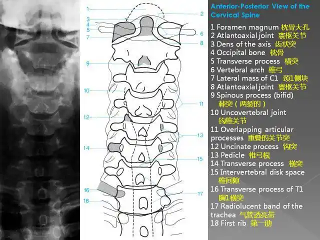 正位片腰椎正位片,可显示腰椎有无侧凸,两侧横突大小有无异常(如第五