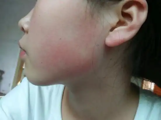 康御肤毛周角化症脸红怎么去除?