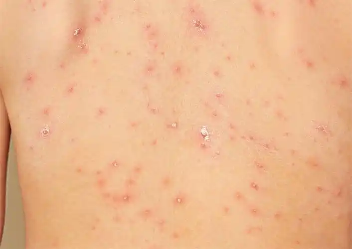 水痘是水痘-带状疱疹病毒初次感染引起的急性传染病,有自愈性.