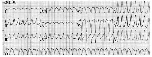室传导阻滞=rr间期恒定 p波与qrs波无关 大炮音 心率40——60次/分11
