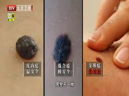 20160303我是大医生视频和笔记连石痣肝癌色素痣黑色素瘤