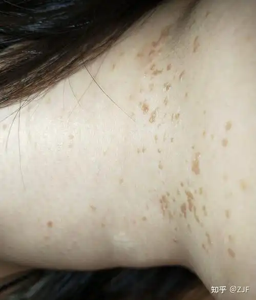 标不治本,过几个月又会长出来,而且越来越多,我那时候身上都长了好多