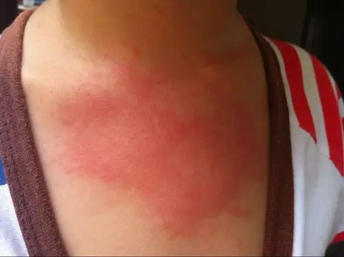 四岁孩子前胸红疹 昨天早上起来脖子就发现红疹,他没说痛痒,我以为是