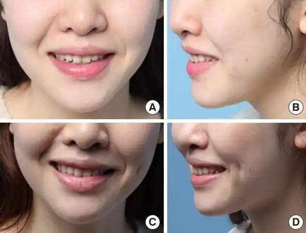 人造酒窝:为了"美",不惜弄残脸部肌肉