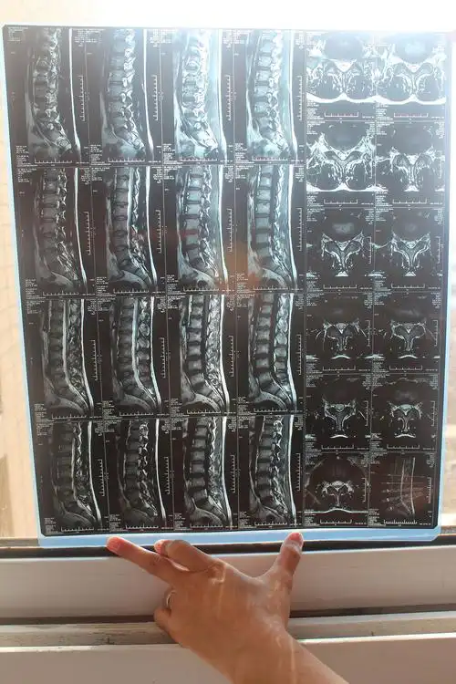 求专家帮忙看看腰椎间盘突出核磁共振图