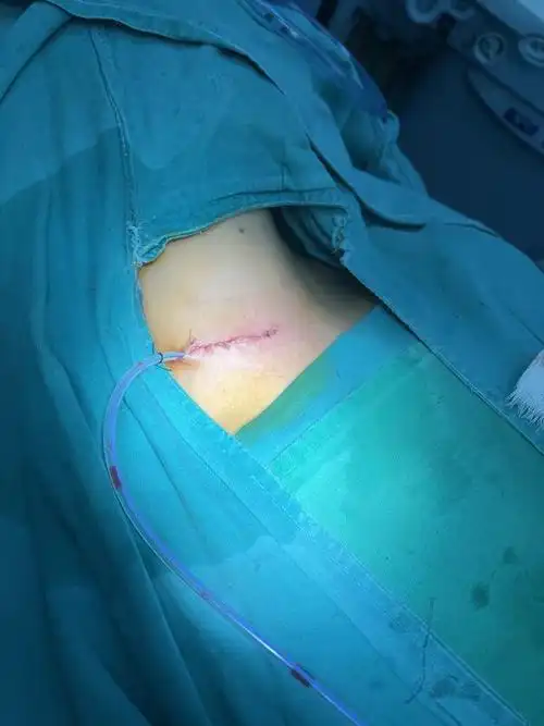 个人经验:正常甲状腺手术,咱们走的是颈白线入路!