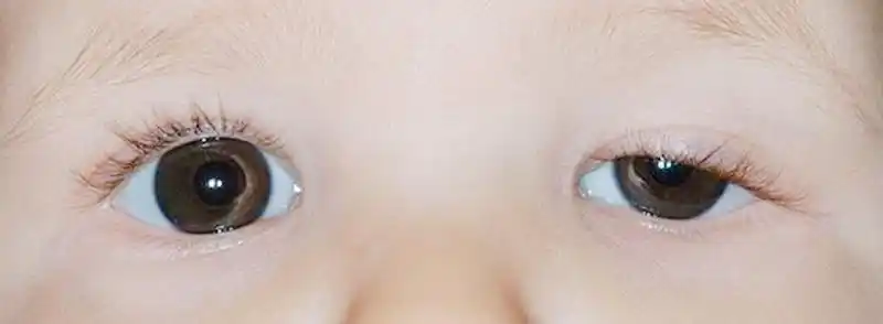 宝宝的眼睛有秘密如果孩子出现这5种怪眼家长一定要警惕