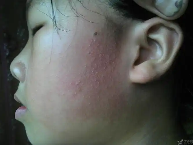 【求助】"面颈毛囊性红斑黑变病?"的诊断及治疗