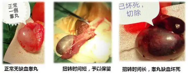 含蛋之事蛋痛不止警惕睾丸扭转