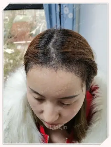 快来看看我植发术后半个月的效果吧!