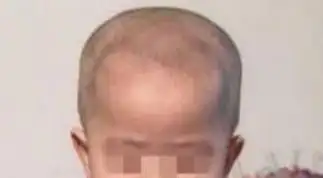 4,孩子 「方颅」?是不是缺钙?