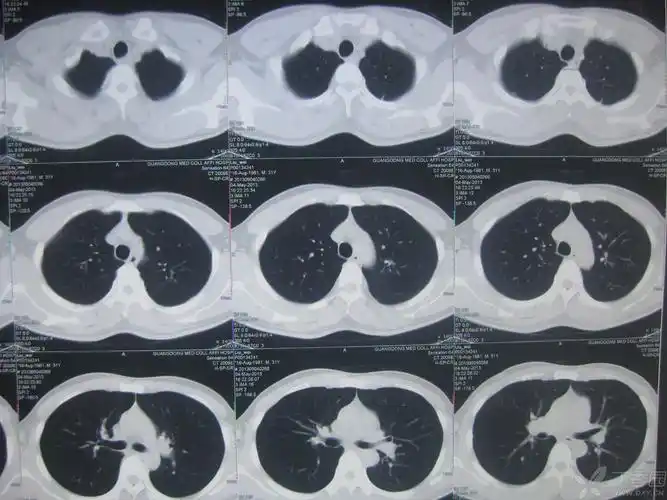 【求助】令人蛋疼的肺结核,请各位老师支招! [病例帖]