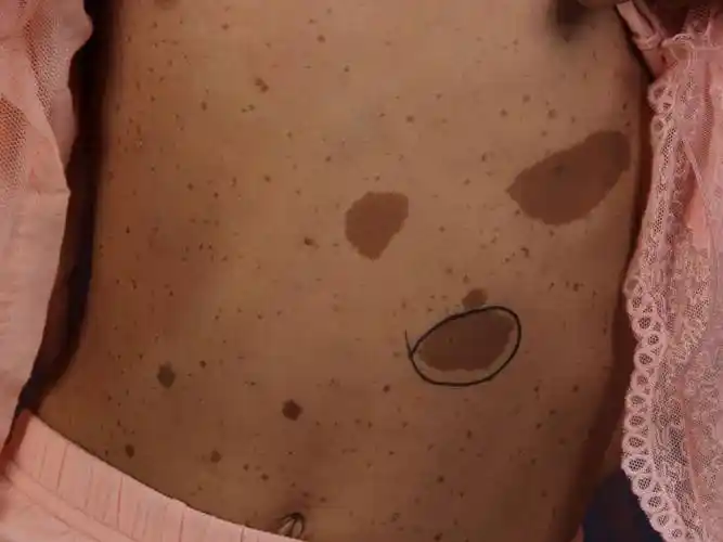 郑州市第二中医院胎记专家表示咖啡斑是能够治愈的.