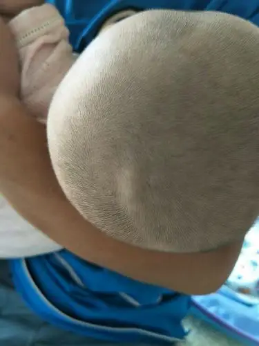 五个月宝宝头顶有个小包,按下去又上来了,还在跳动,去南京南京市儿童