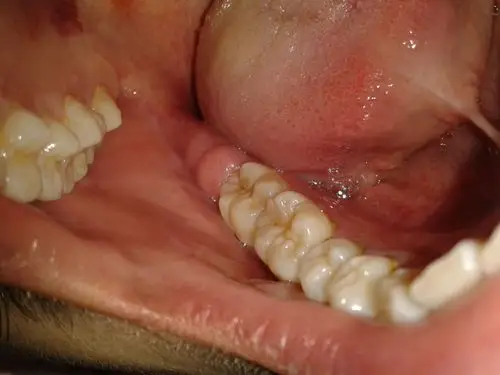 下排最右边牙齿旁边的那块肉疼 还肿了