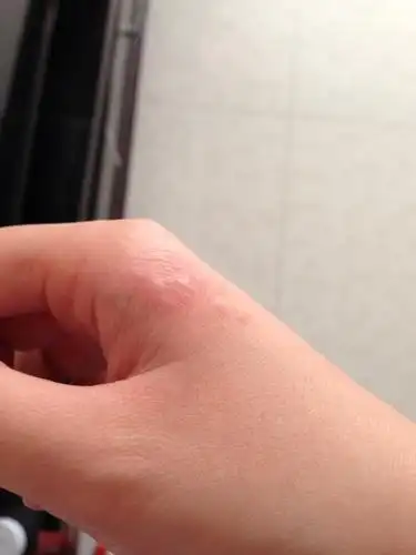 手上长了小水泡,微痒,反复会慢慢爆皮然后在长.这到底是什么?